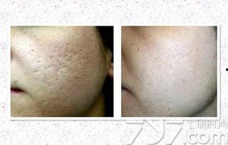 激光去痘坑视频,见证肌肤平滑奇迹